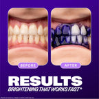 Before and after dental whitening treatment on a purple background