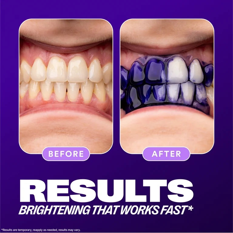 Before and after dental whitening treatment on a purple background
