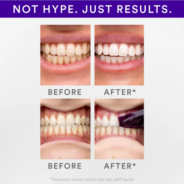 SMILE Purple Teeth Whitening Strips